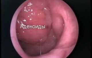 Аденоиды в носу у детей