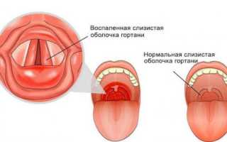 Симптомы и лечение ларингита