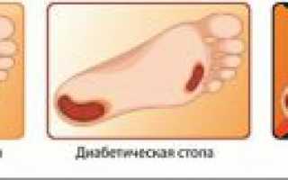 Гангрена ноги: как предотвратить грозное осложнение сахарного диабета