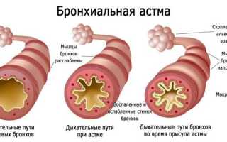 Бронхиальная астма — что это