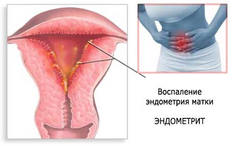 Эндометрит матки