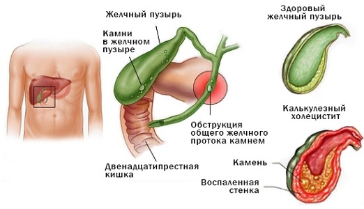 Почему болит бок перед критическими днями