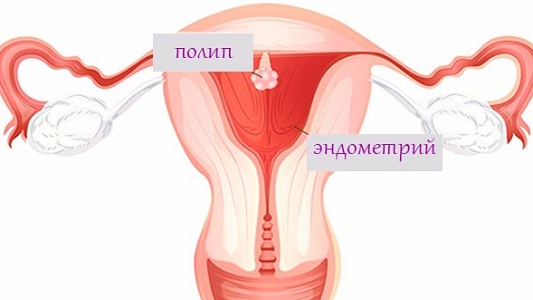 Кровотечение при климаксе при наличии полипа эндометрия