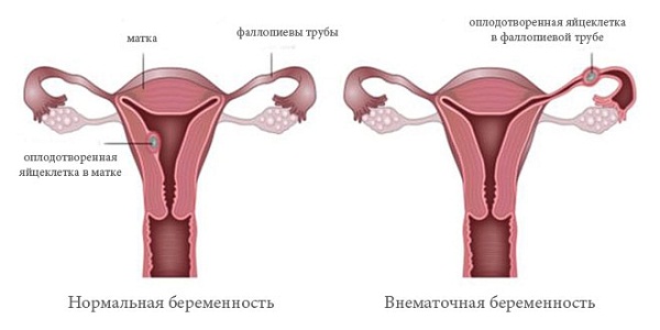 Причины низкого уровня ХГЧ