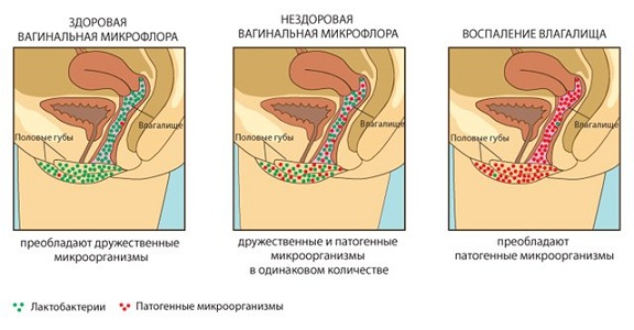 Риск развития эндометрита у женщин