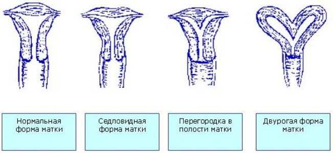 Варианты двурогой матки