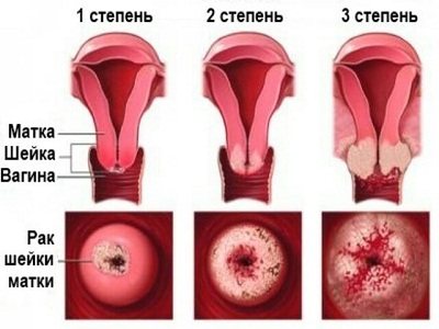 Выделения у женщин после климакса