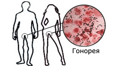 Гонорея у женщин