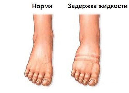 Задержка жидкости в организме перед месячными