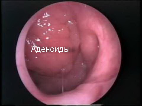 Аденоиды у детей