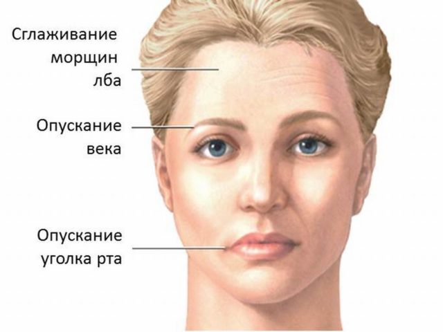 Неврит лицевого нерва