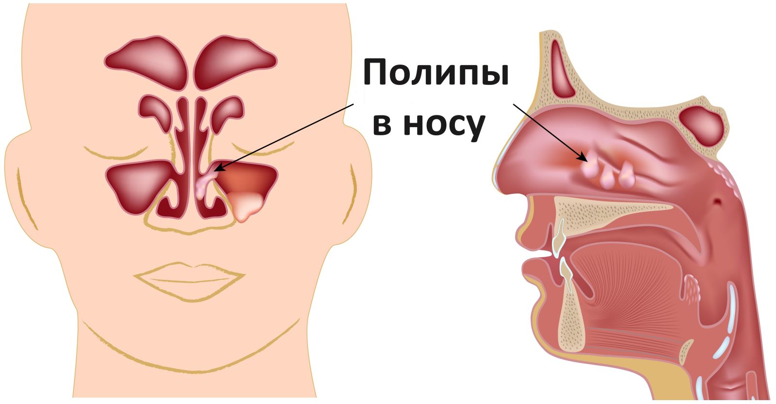 Полипы в носу