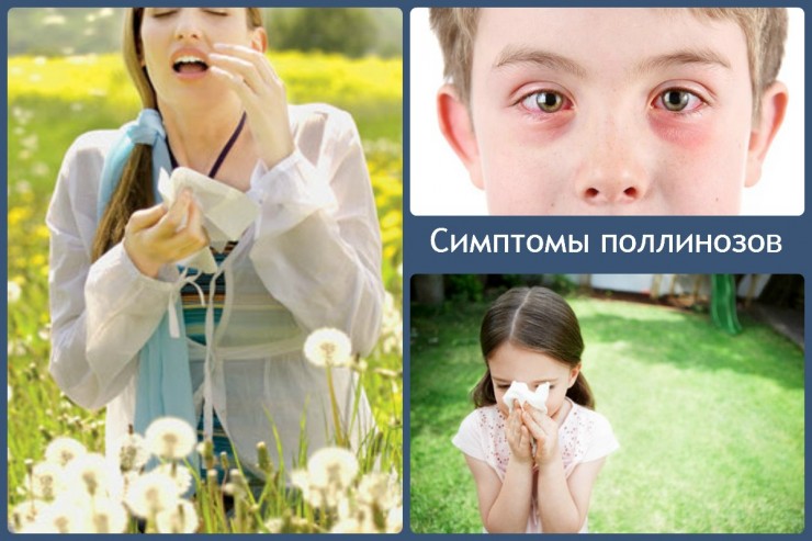 Симптомы поллиноза